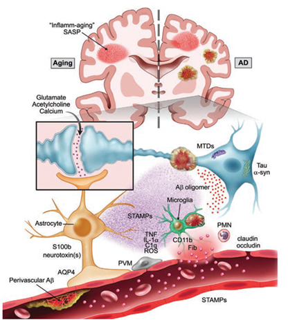 FigURE 1: Putative mechanisms involved in the pathogenesis of postoperative delirium during aging and neurodegeneration. Aging and dementia are the most significant risk factors for delirium. Both states are characterized by chronic inflammation (including inflamm-aging). The AD brain has additional hallmarks of vulnerability, herein the focus is on pre-existing Aβ pathology. Surgery triggers a systemic inflammatory response that can disrupt the blood-brain barrier (BBB) and amplify delirium risk in patient