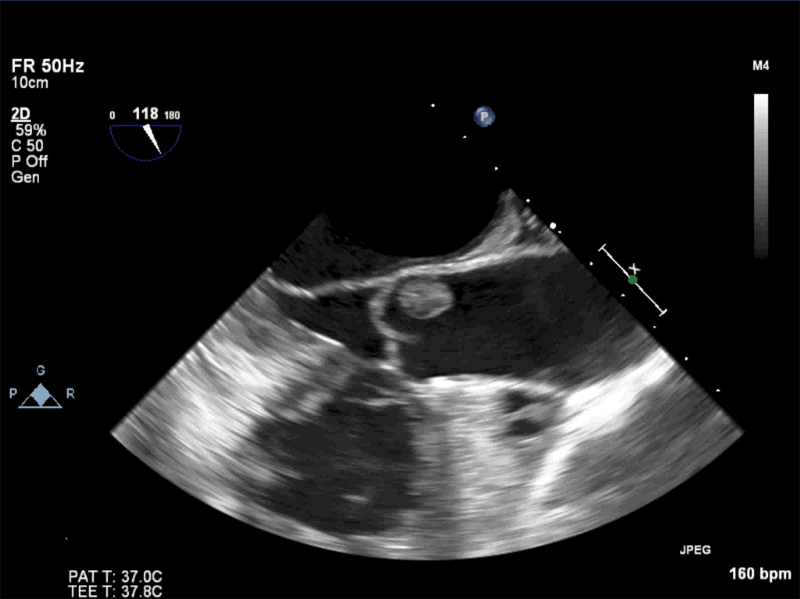 AV LAX showing mobile mass attached to the left or non-­coronary cusp