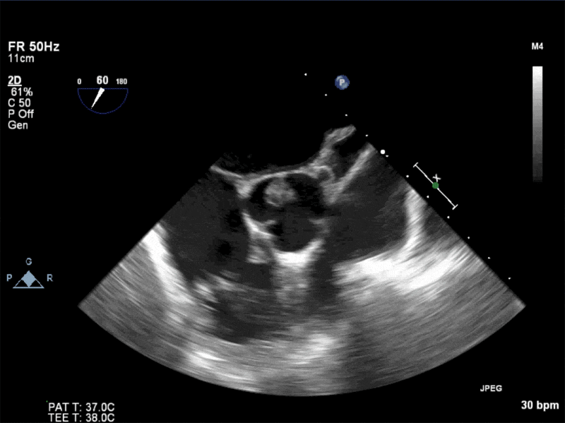 AV SAX showing mobile mass attached to the non-coronary cusp