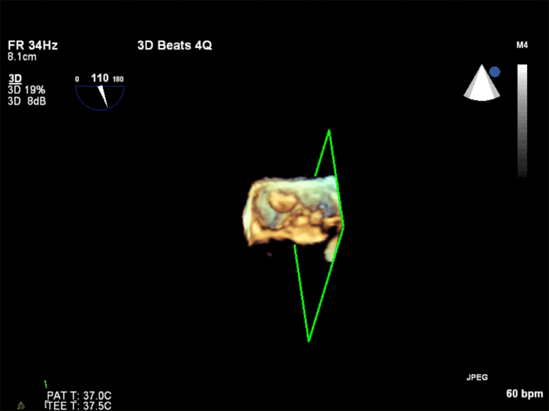 AV Short Axis – 3D Cropped showing attachment point of the mobile mass at the base of the non-coronary cusp