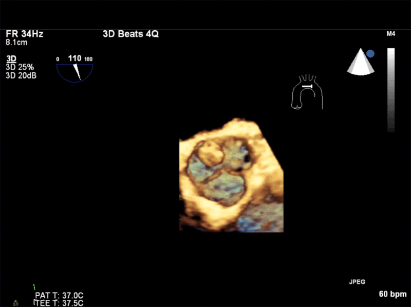 AV Short Axis – 3D view of the aortic valve from the ascending aorta showing mobile mass attached to the non-coronary cusp