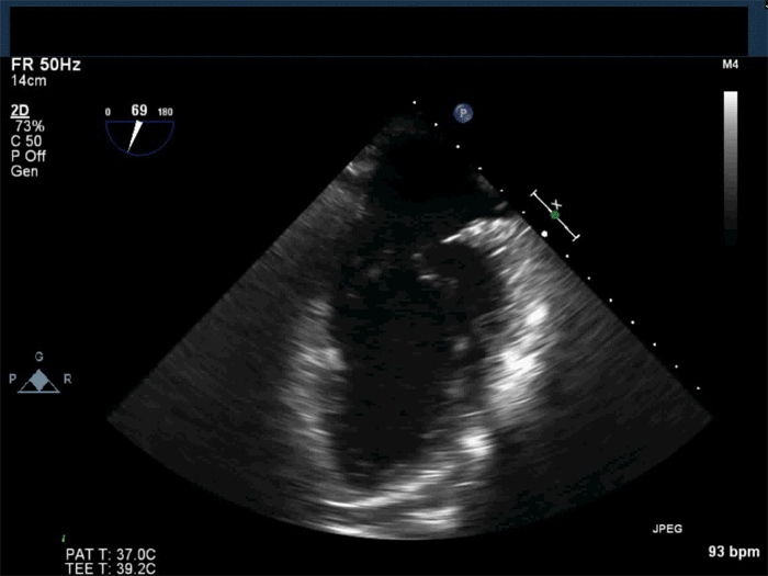 ME mitral commisural view