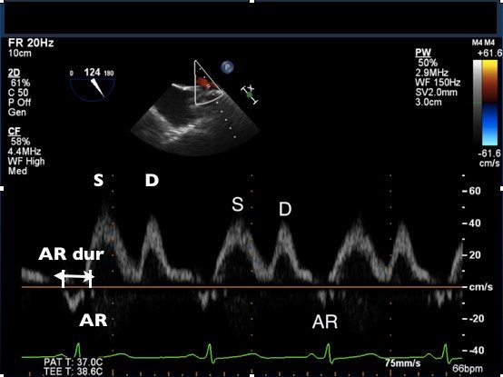 Pulmonary Venous Flow Ultrasound