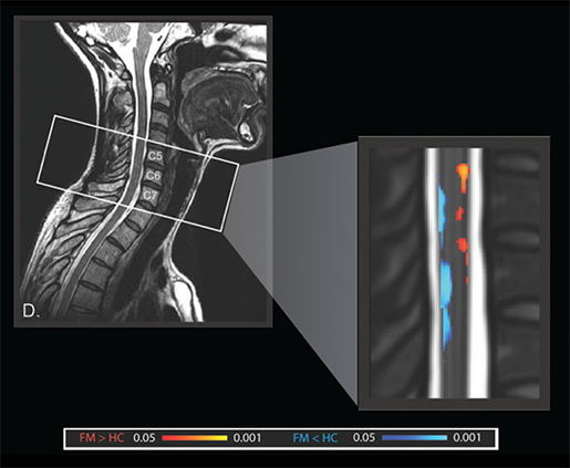 Sagittal view of group (patient vs. healthy control) differences in spinal cord fMRI activity.