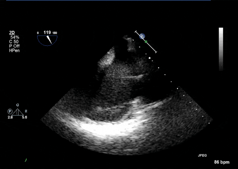 Dilated coronary sinus in a modified midesophageal bicaval view