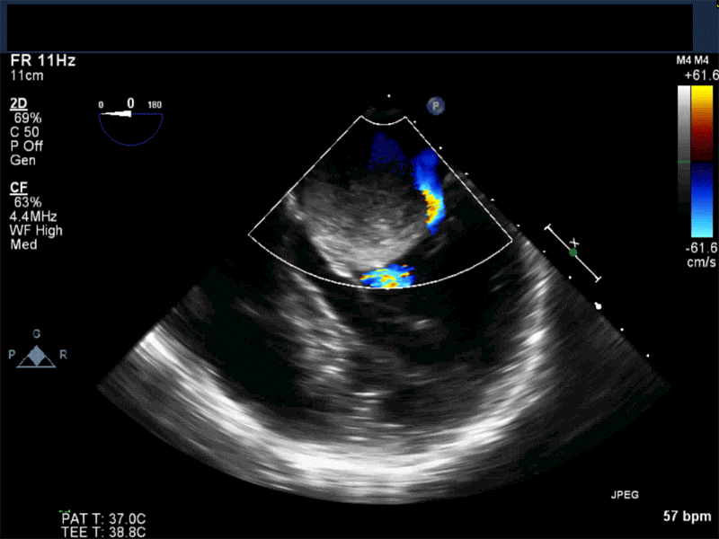 Midesophageal 4-chamber view with color flow Doppler