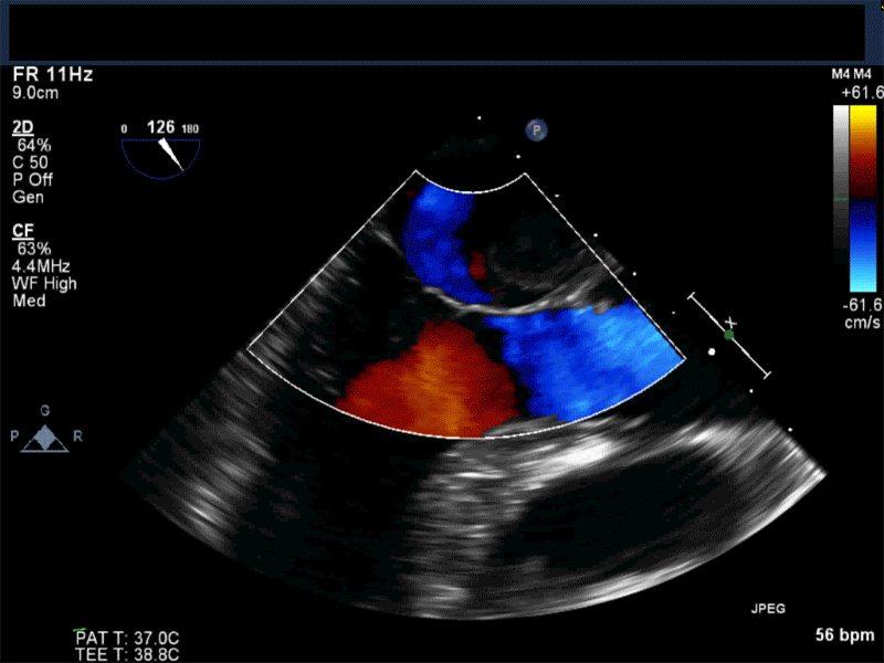 Midesophageal long axis view with color flow Doppler