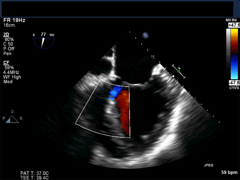 Non-­standard midesophageal mitral commissural view