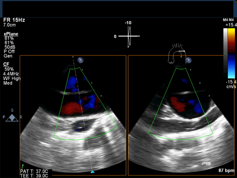 X plane view of the aortic arch