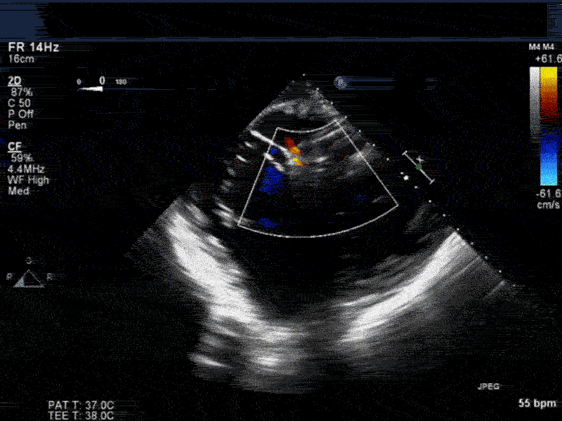 Transgastric short axis midpapillary view with color flow Doppler 