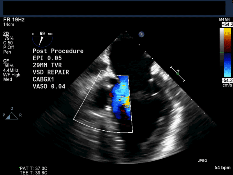 Non-­standard midesophageal mitral commisural view