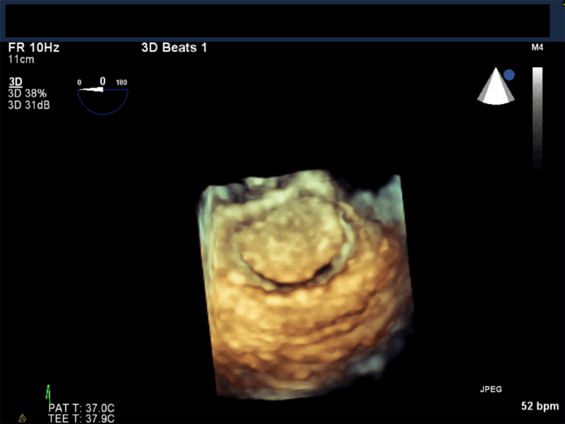En-face 3D view of the mitral valve