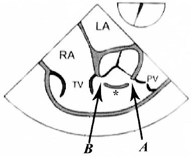 Figure1: ME RV inflow-­‐outflow. A: supracristal (subarterial, outlet, subpulmonic, infundibular) B: infracristal (perimembranous, subaortic)
