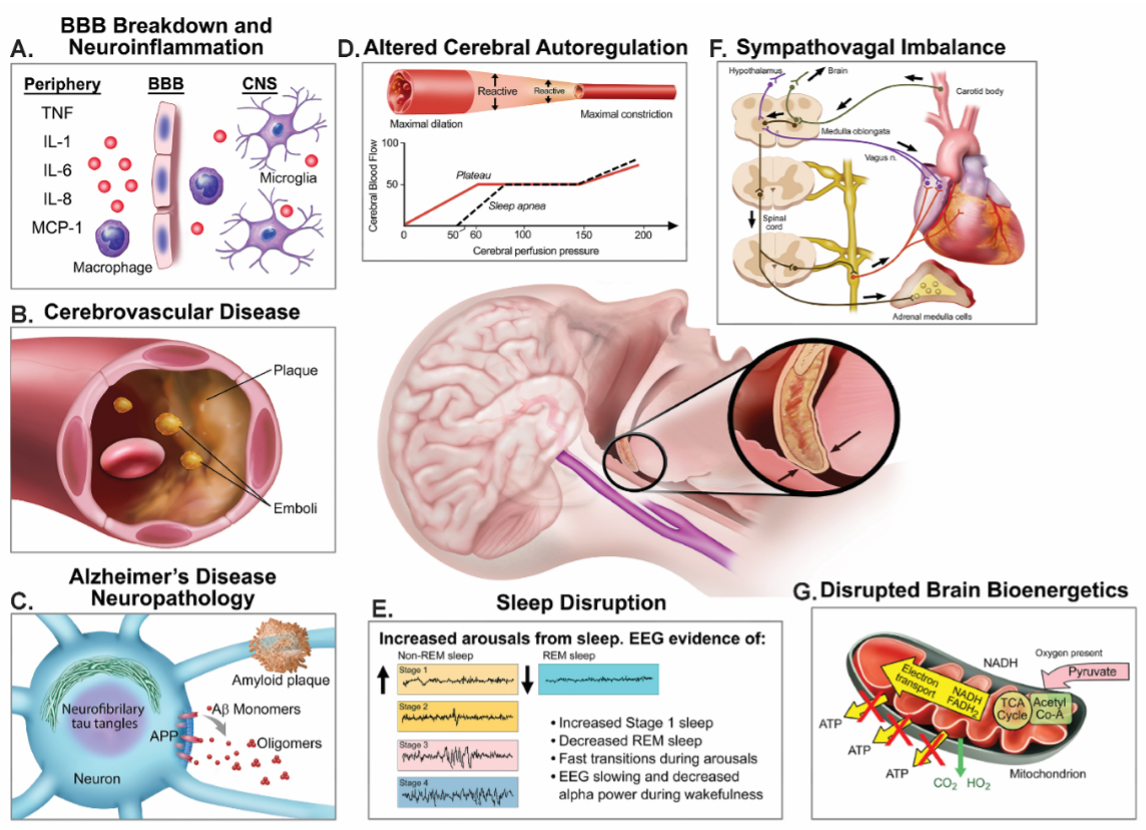 Potential mechanisms underlying delirium in patients with sleep disruptions.