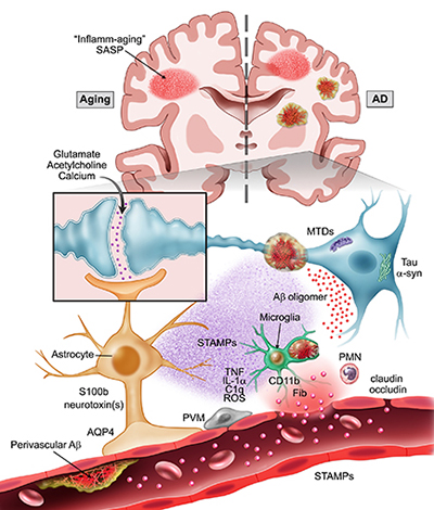 Possible mechanisms underlying postoperative delirium in aging and neurodegeneration (see DOI: 10.1002/alz.12064).