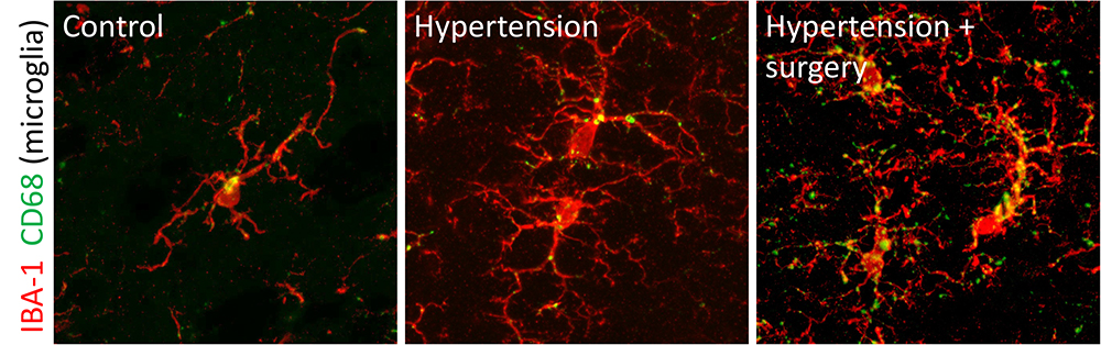 Representative images of neuroinflammation (i.e. microglial activation) in mice with hypertension and following anesthesia and surgery (orthopedic). Image courtesy of Terrando/Yang labs.